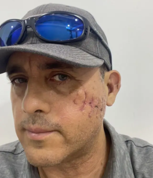 Mauricio Hoyos, mexicano que sobrevivió a la mordida de un tiburón en la cabeza, narra su increíble experiencia.